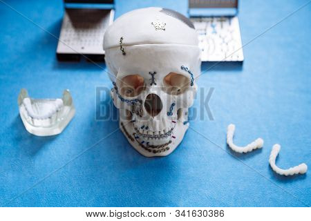 The Model Of The Skull For Maxillofacial Surgery And Dentistry Lies On A Table With Plates Screwed I