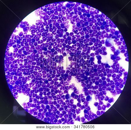 Group Of Inflammation Cells Ascitic Fluid Sample Laboratory Concept.