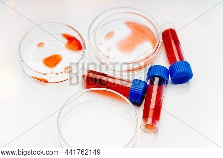 Blood Test Analysis With Petri Dish Close Up.blood Coronavirus Test.virus Vaccine Development.medica