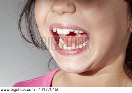 A Caucasian Girl With Teeth Crowding Is Showing The Inside Of Her Mouth In A Dentist Exam Room. One 