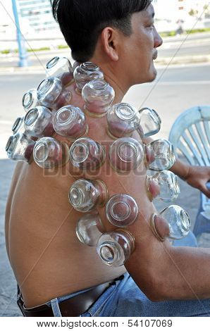 Cupping therapy in Saigon, Vietnam