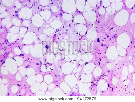 Liposarcoma of a human