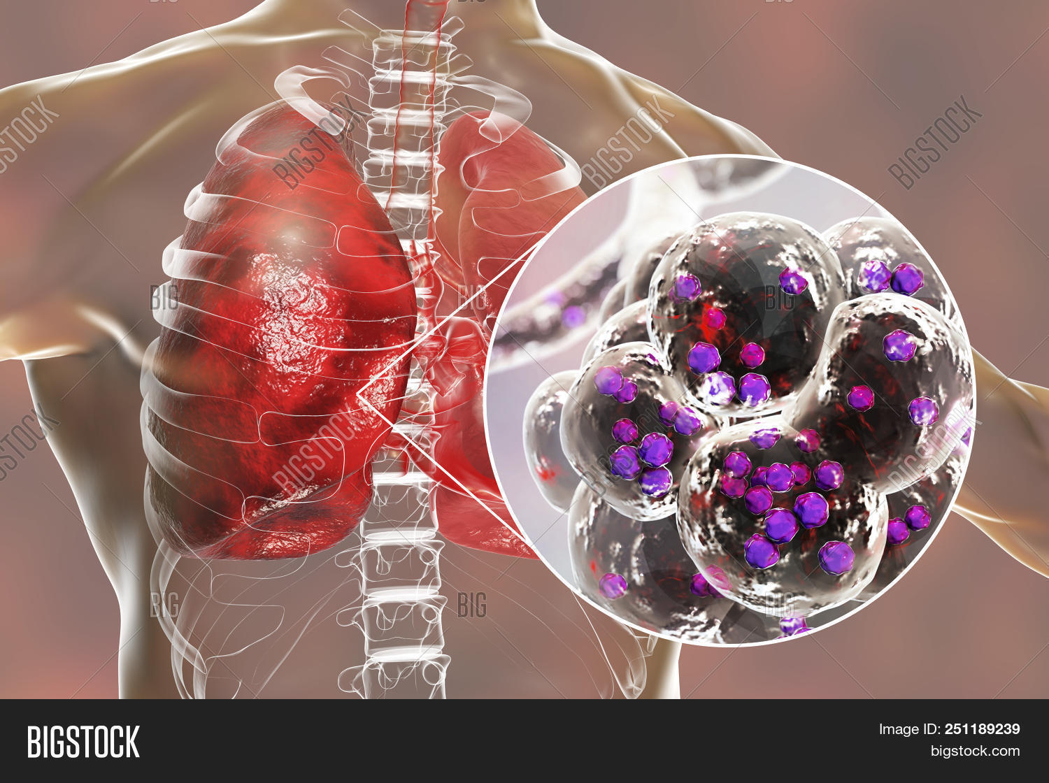 Staphylococcal Image & Photo (Free Trial) Bigstock