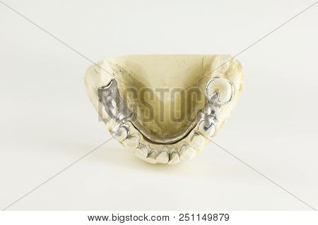 Steel Base Of The Clasp Prosthesis On The Gypsum Model