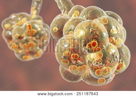 Pneumococcal Pneumonia, Medical Concept. 3d Illustration Showing Bacteria Streptococcus Pneumoniae I