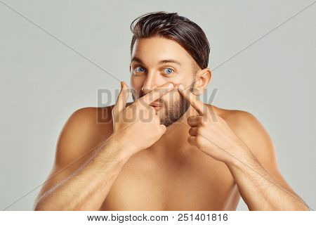 Young Man Squeezing Her Pimple, Removing Pimple From Her Face. Man Skin Care Concept. Acne Spot Pimp