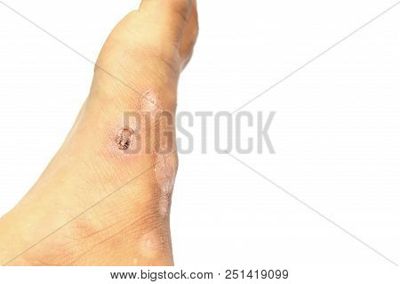 Foot Of A Child With A Wound Caused By Infection.inflammation Of The Skin Caused By Scabies.a Common