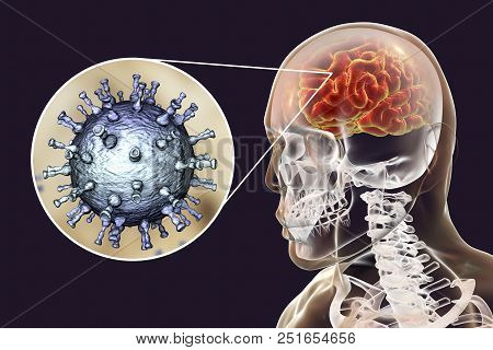 Varicella Zoster Virus Vzv Encephalitis, Medical Concept, 3d Illustration Showing Brain Infection An