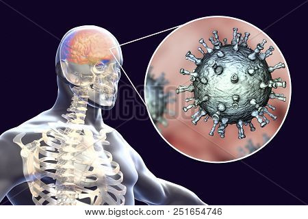 Varicella Zoster Virus Vzv Encephalitis, Medical Concept, 3d Illustration Showing Brain Infection An