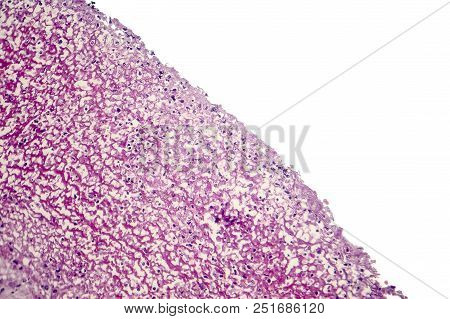 Bacterial Dysentery, Light Micrograph, Photo Under Microscope Showing Accumulation Of Inflammatory C