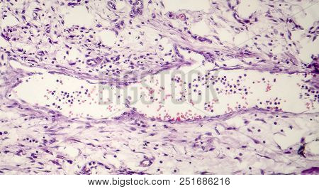 Bacterial Dysentery, Light Micrograph, Photo Under Microscope Showing Accumulation Of Inflammatory C