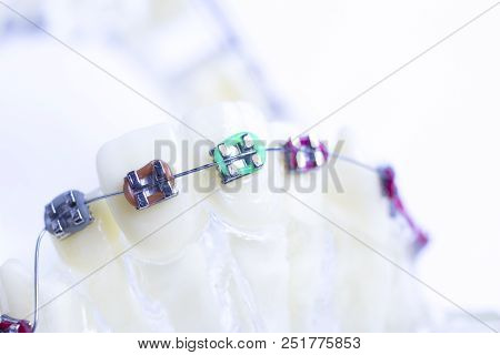 Dental Metal Brace Teeth Model