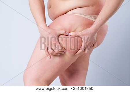 Overweight Woman With Fat Thighs, Obesity Female Legs