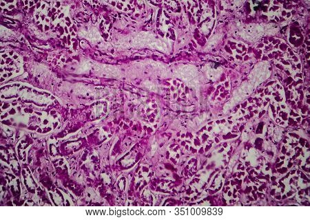 Histopathology Of Diffuse Sclerosing Glomerulonephritis, Light Micrograph, Photo Under Microscope