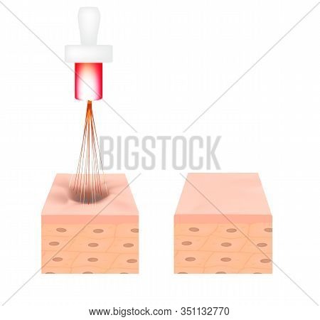 Acne Scars. Laser Scar Atrophic Treatment. The Anatomical Structure Of The Skin With Acne. Illustrat