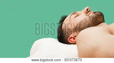 Acupuncture Needles For Treating A Mans Headache. Traditional Chinese Medicine