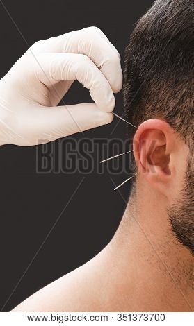 Acupuncture Treatment For Tobacco Or Alcohol Addiction. Traditional Chinese Medicine Will Help Get R