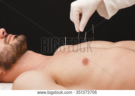 Acupuncture Needles In Reflexologist Hand Close Up On Black Background. Treating Diseases Using Ches