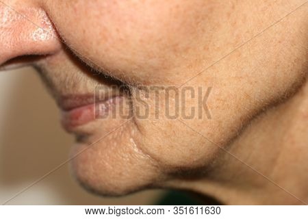Nasolabial Wrinkles. Wrinkles On The Skin Of The Face Of The Neck. Flabby Cheeks And Neck