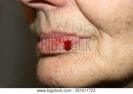 Herpes On The Lip. Blood On The Lip.