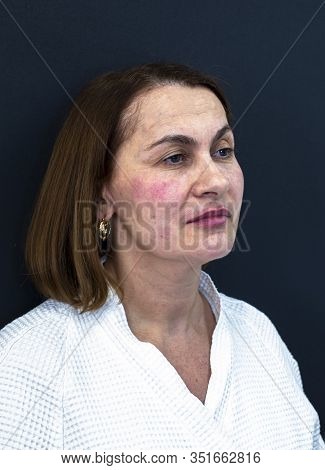 An Elderly Woman Immediately After Injections Of Botulinum Toxin, Closeup. Skin Care Concept. Aethet