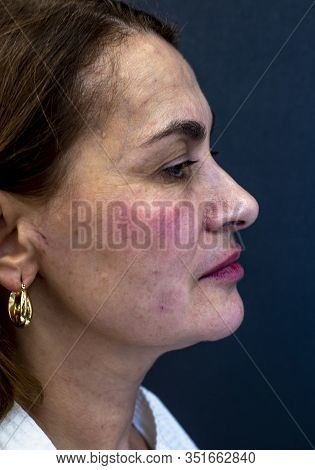 An Elderly Woman Immediately After Injections Of Botulinum Toxin, Closeup. Skin Care Concept. Aethet