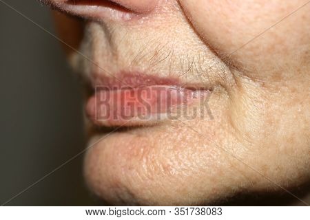 Nasolabial Wrinkles. Wrinkles On The Skin Of The Face Of The Neck. Flabby Cheeks And Neck