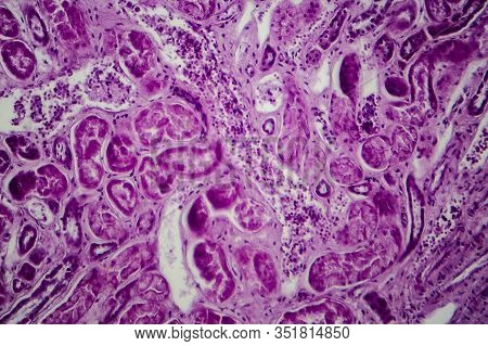 Diffuse Proliferative Glomerulonephritis, Dpgn, Light Micrograph, Photo Under Microscope
