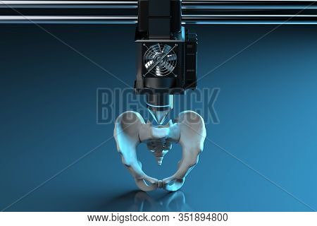 3D Printer Print Prosthetic Hip Bone
