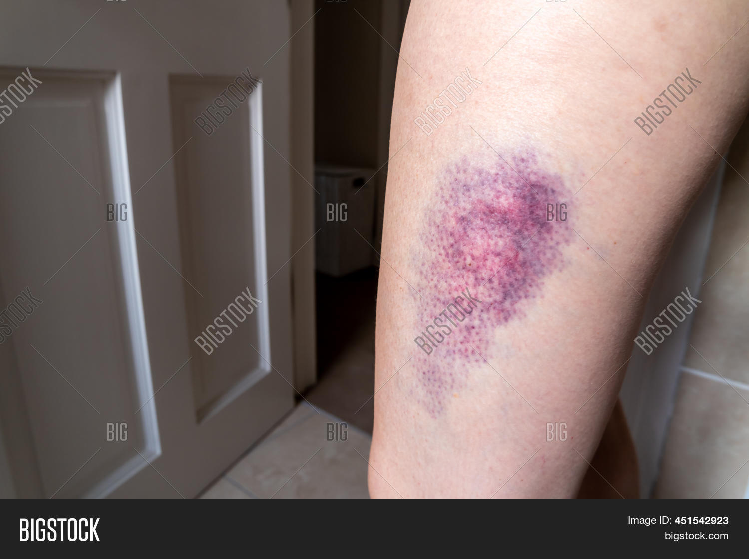 Terrible Bruise On Image & Photo (Free Trial) Bigstock