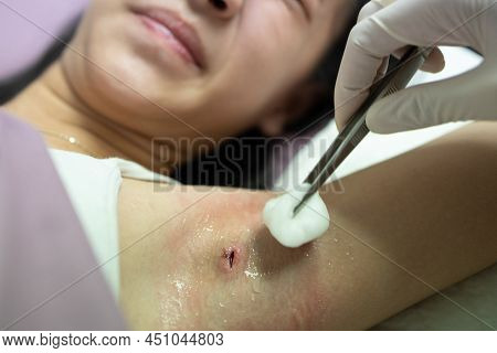 Woman Nurse With Gloves Using Tweezers,cotton Wool,cleans It With Antiseptic Or Normal Saline Soluti