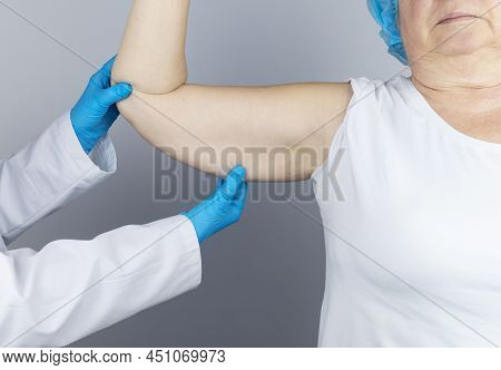 Brachioplasty. Plastic Arms, Dangling Skin At The Elbow. An Older Woman Shows The Surgeon Problem Ar