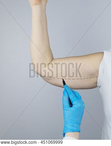 Brachioplasty. Plastic Arms, Dangling Skin At The Elbow. An Older Woman Shows The Surgeon Problem Ar