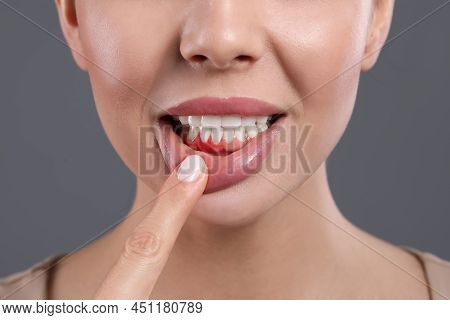 Young Woman Showing Inflamed Gums On Grey Background, Closeup