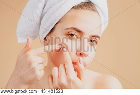 Close Up Beautiful Girl Squeezing Pimples On Her Face. Acne Blemish Spots Skin On Young Woman. Spot 