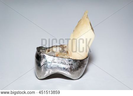 Close-up Of A Dental Crown, Together With One Half Of The Root On Which A Root Resection Was Perform