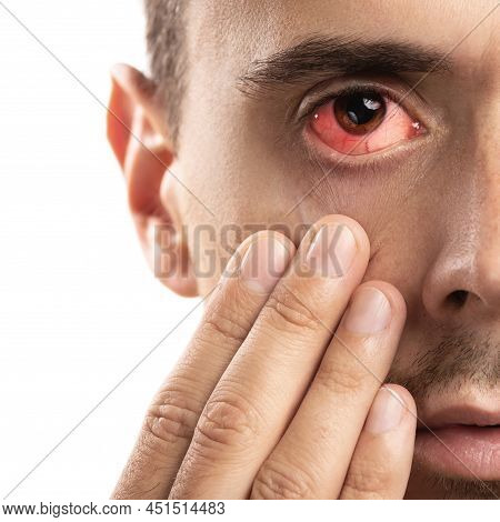 Man With The Subconjunctival Hemorrhage In His Eye