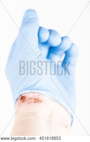 Chemical Burn On The Wrist Skin With Hydroxide Sodium Acid, By Striping Paint From Wood. Festering A