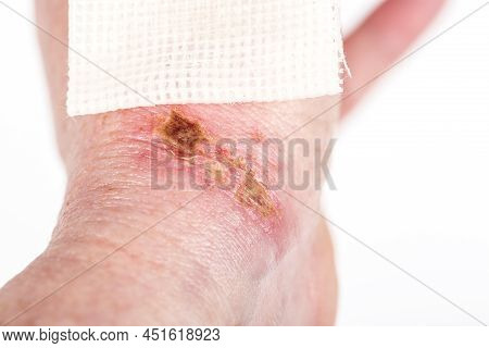 Chemical Burn On The Wrist Skin With Hydroxide Sodium Acid. Festering And Deep Wound. Household Acci