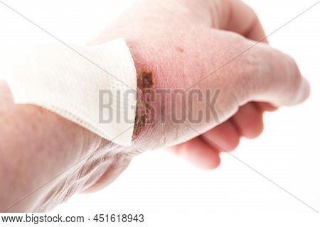 Chemical Burn On The Wrist Skin With Hydroxide Sodium Acid. Festering And Deep Wound. Household Acci