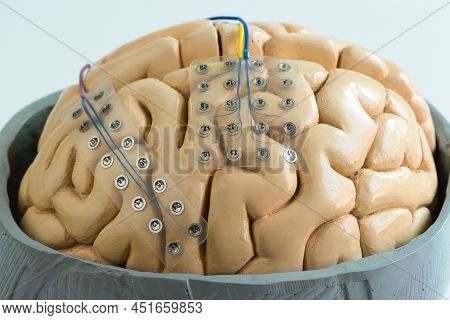 Close-up View Of Subdural Grid Electrode For Brain Waves Recording Or Electroencephalography On The 