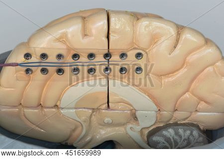 Close-up View Of Subdural Electrode For Recording Brain Waves Or Electroencephalography On Medial Su