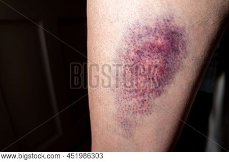 Terrible Bruise On The Upper Leg Of A Woman