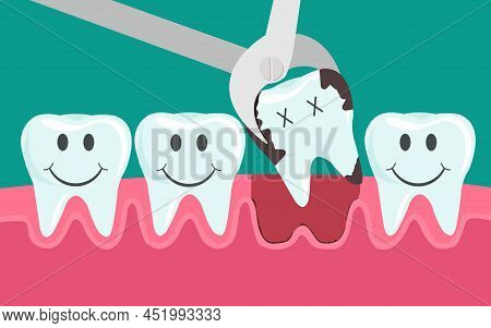 Illustration Of Tooth Decayed. Tooth Is Removed With Tweezers In The Oral Cavity. Concept Of Childre