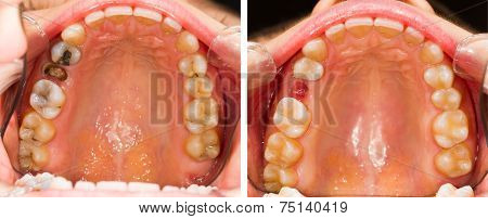 Tooth Extraction And Resin
