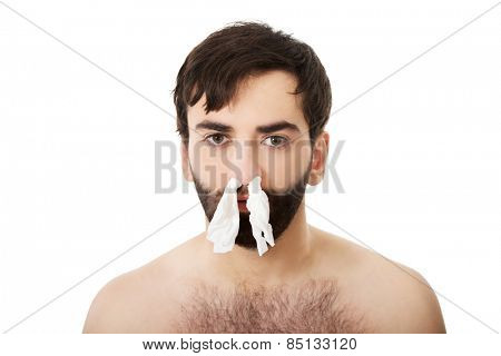Poor sick man with tissues in nose.