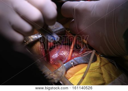Surgeon pinches the tube and blocks the blood circulation during the open heart surgery