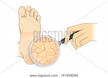 Zoom in cracked heel with magnifier on isolated. Illustration about beauty foot skin.