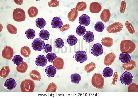 Acute Lymphoblastic Leukemia, Bone Marrow Smear, 3d Illustration