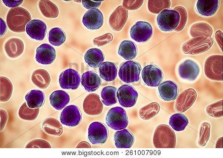 Acute Lymphoblastic Leukemia, Bone Marrow Smear, 3d Illustration